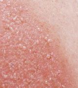 Image result for Blisters From SunBurn