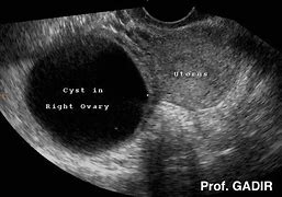 Image result for 5 Cm Ovarian Cyst