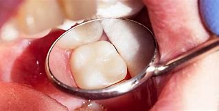 Image result for Embedded Teeth