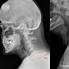 Image result for C-spine X-ray