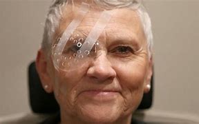 Image result for Eye Shield After Cataract Surgery