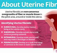 Image result for Uterine Fibroid Size