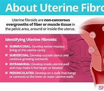 Image result for 8 Cm Uterine Fibroid Picture