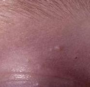 Image result for Molluscum Treatment with Laser