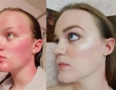 Image result for Bad Sunburn Lady