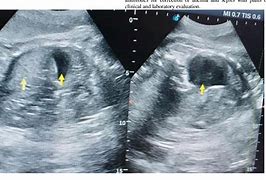 Image result for Intrauterine Fetal Demise Skin