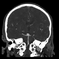 Image result for Cor MIP CTA