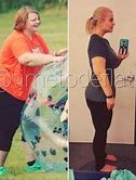 Image result for Mini Bypass Weight Loss