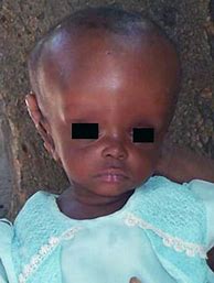 Image result for Hydrocephalus