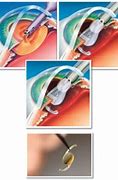 Image result for Drawing of Intraocular Lens Implant