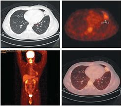 Image result for Carcinoid Tumor CT Scan