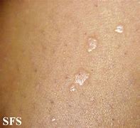 Image result for Skin Warts Treatment