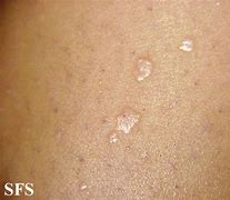 Image result for Types of Warts On Skin