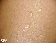 Image result for How to Get Rid of Flat Warts