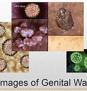 Image result for Genital Warts Symptoms Disease