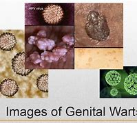 Image result for Warts and HPV Virus