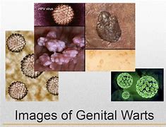 Image result for Male Genital Warts Disease