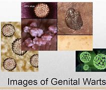Image result for Genital Warts and HIV