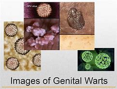 Image result for Genital Warts Symptoms