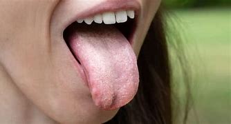Image result for Yeast Infection On Tongue