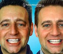 Image result for Crooked Teeth Before and After Braces