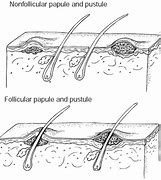 Image result for Papules On Dogs