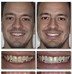 Image result for Invisalign Crowding Before and After