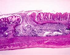 Image result for amebiasis