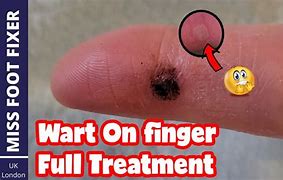 Image result for Medical Wart On Finger Removal
