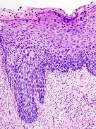 Image result for Cervical Warts