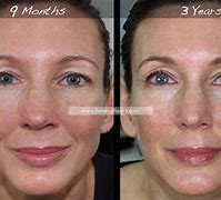 Image result for Retin a Before and After