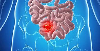 Image result for 10 Cm Tumor in Colon