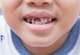 Image result for Kids with Rotten Teeth