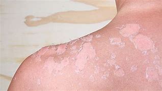 Image result for bad sunburn blisters