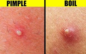 Image result for What Does an Infected Burn Look Like