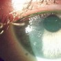 Image result for Lasik Corneal Scar