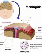 Image result for Meningitis Bacterial Disease