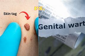Image result for Genital Skin Tags