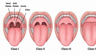 Image result for HPV On Uvula