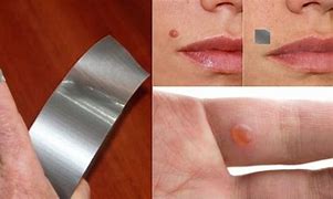 Image result for Wart Removal Home Remedies