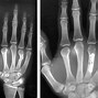 Image result for fractured pinkie fingers heal time