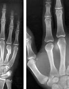 Image result for Broken Hand Cast