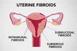Image result for Uterine Fibroid Cysts