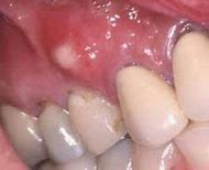 Image result for Bump On Gum After Tooth Extraction