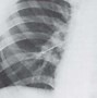 Image result for Left Side Pneumothorax