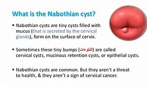 Image result for Types of Cysts On Cervix