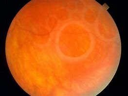 Image result for Retina Cyst