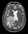 Image result for Intraventricular Meningioma