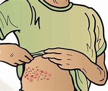 Image result for Shingles