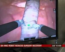 Image result for Robotic Colon Surgery